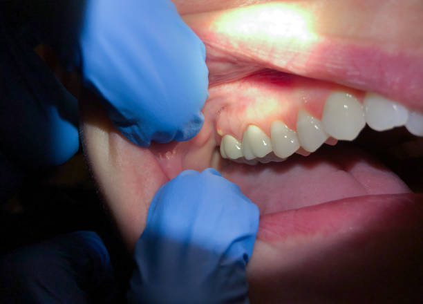Best Emergency Dental Care for Abscessed Tooth in Vley, AL