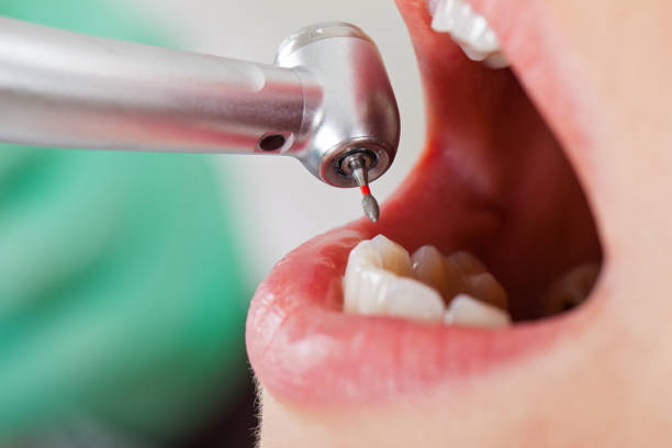Best Emergency Root Canal Treatment in Vley, AL